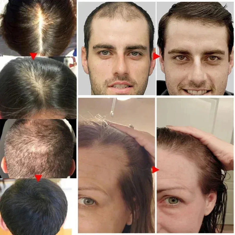 kf-Sff5bceb0726b4dd1afeb7e96797272c2Y-Biotina-Crescimento-Do-Cabelo-Soro-Anti-Hair-Loss-Produtos-Fast-Growing-Prevenir-Seco-Frizz-Repara-o