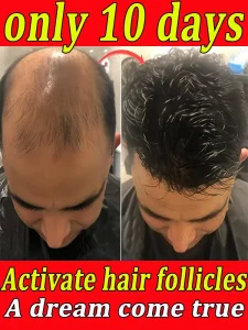 Cosméticos e outros produtos de beleza Essência de Crescimento Capilar – Nutrição Profunda do Couro Cabeludo e Estímulo aos Folículos para Rápido Crescimento em 7 Dias | Loja dos Cabelos