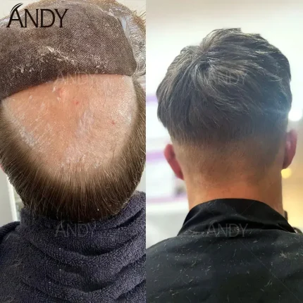 Prótese Capilar Masculina Cabelo Humano Invisível Linha Natural Lisboa